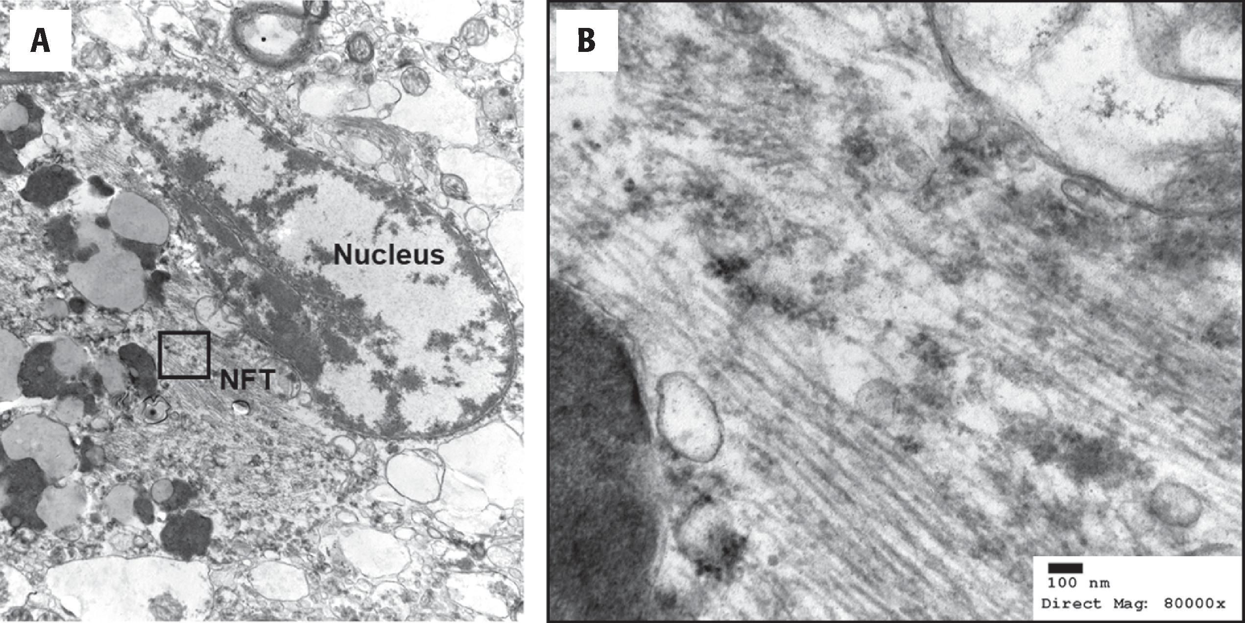 Figure 6.4, Ultrastructural features of a neurofibrillary tangle in the cytoplasm of a neuron (A). The neurofibrillary tangle (NFT) contains tau and consists of paired helical filaments (B). This image is from a neuron in the amygdala of a patient with late-onset Alzheimer disease. ( Courtesy Clair Haueter, CEMT, electron microscopy laboratory at Houston Methodist Hospital. )