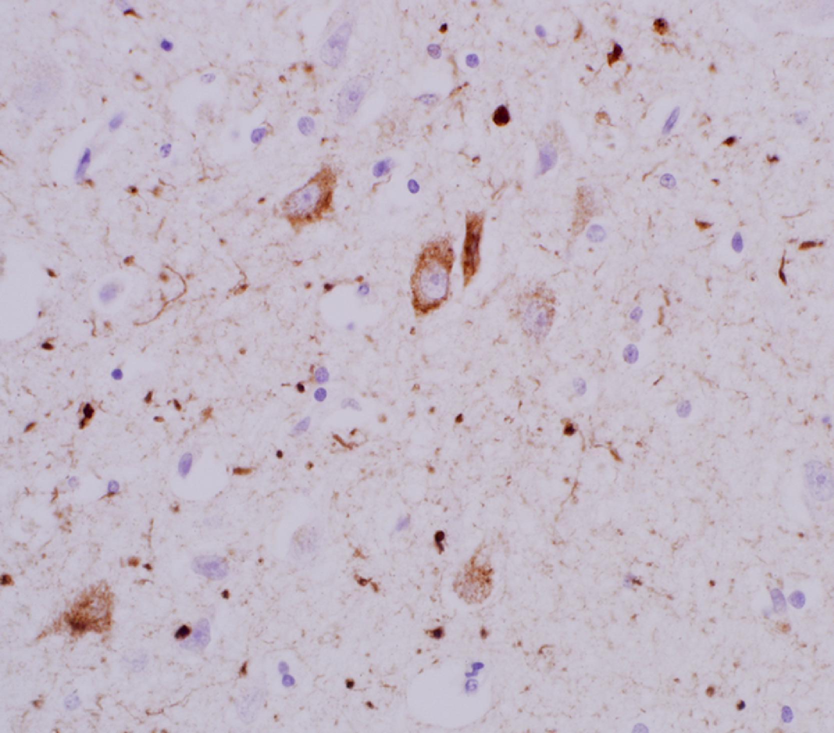 Figure 6.5, Pretangles as visualized by phospho-tau staining. Pretangles are non-fibrillar, granular deposits of tau that are common in various neurodegenerative diseases. Here, pretangles are shown in an elderly patient with concomitant, tau-positive argyrophilic grain disease pathology.