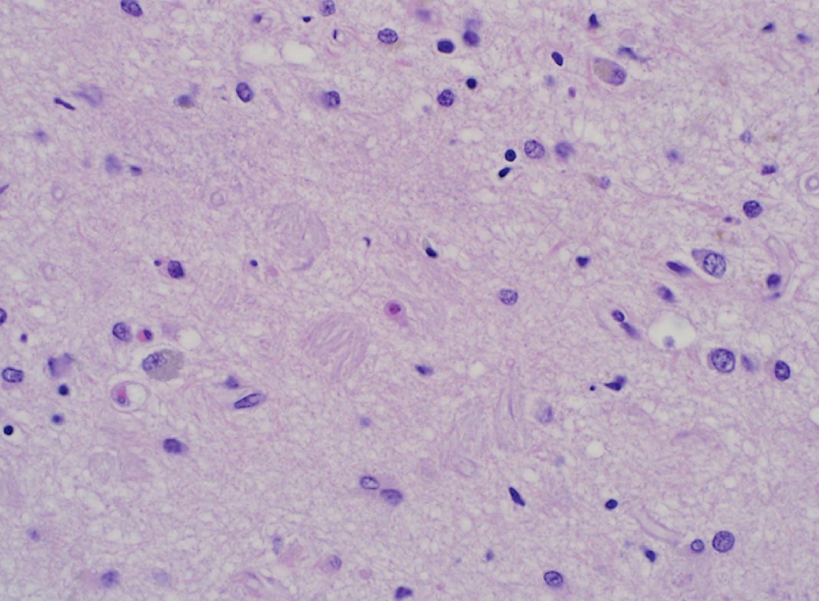 Figure 6.6, Extracellular (“ghost”), tangles in lamina II of the entorhinal cortex (H&E stain). These structures, indicative of neuronal loss in superficial entorhinal cortex, are first seen in the limbic Braak and Braak neurofibrillary tangle stages (III, IV).