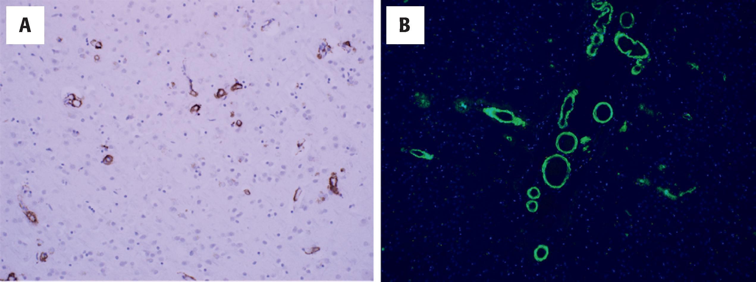 Figure 6.7, Cerebral amyloid angiopathy (CAA) may be identified in arterioles and capillaries by Aβ immunostain (A) or using other techniques, such as staining with 1% thioflavin S (B). Here, cortical arterioles (A) and leptomeningeal and cortical arterioles (B) are shown. Occipital cortex is a frequent site for CAA along with the cerebellum.