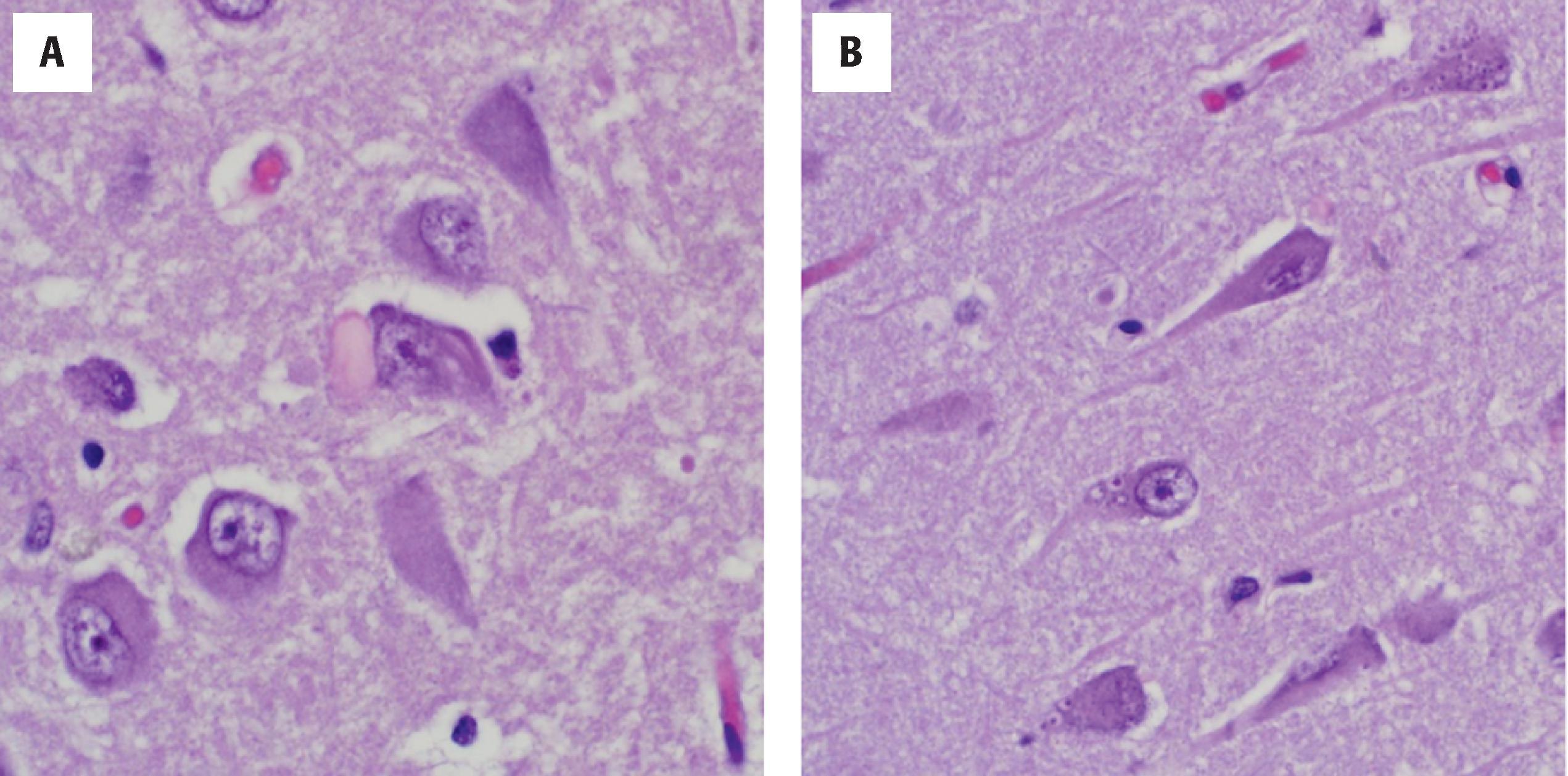 Figure 6.8, Hirano body, center (A), and cytoplasmic foci of granulovacuolar degeneration in multiple neurons (B) (H&E stains). These structures are often identified in close association with one another.