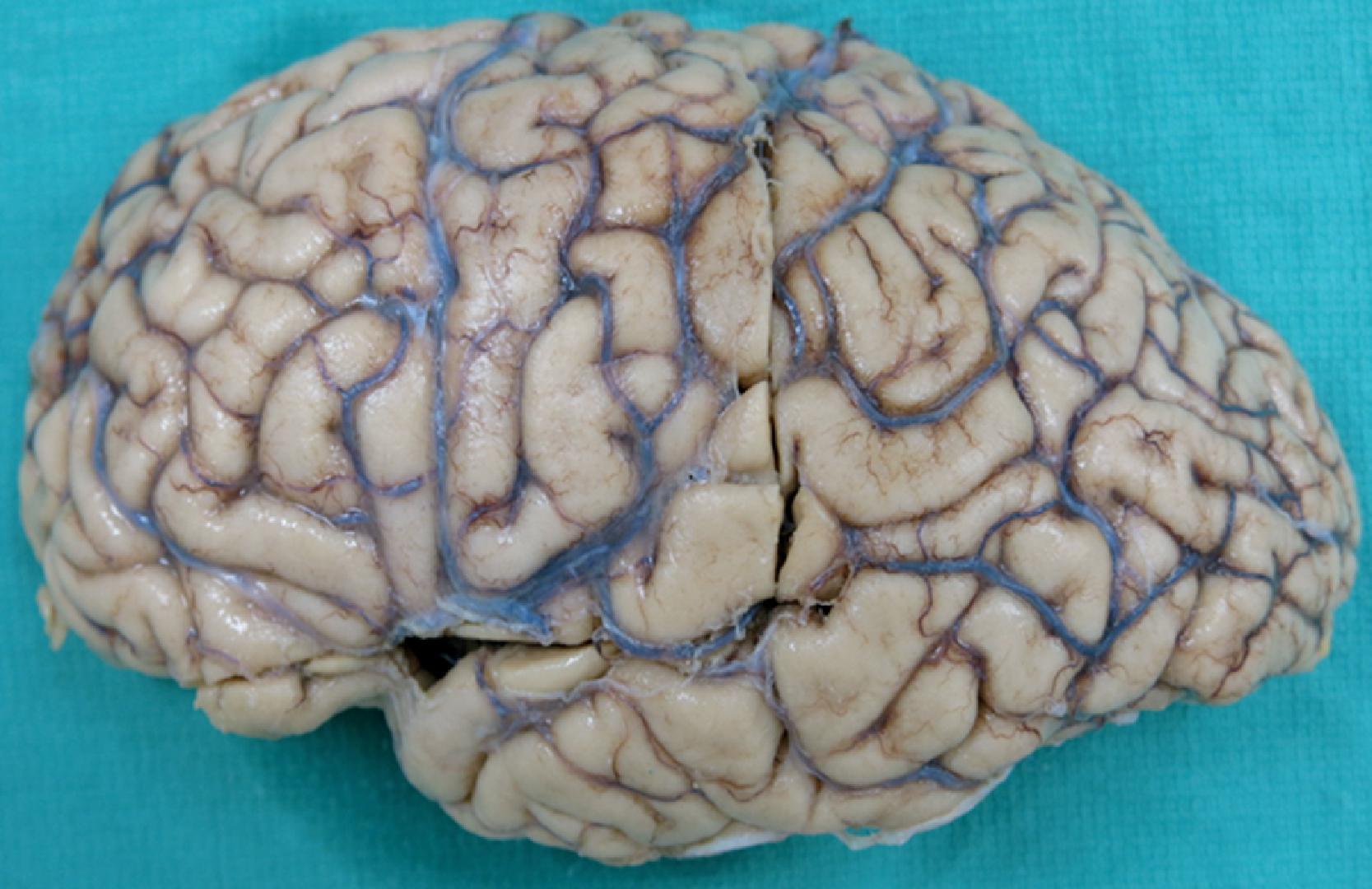 Figure 6.9, Gross examination of the dementia with Lewy bodies (DLB) brain typically reveals only mild frontal atrophy, or no obvious atrophy (this example), and brain weight often exceeds 1300 g. A critical diagnostic feature of DLB is the presence of Lewy bodies in limbic regions and in deeper laminae of the neocortex by microscopy (see text).