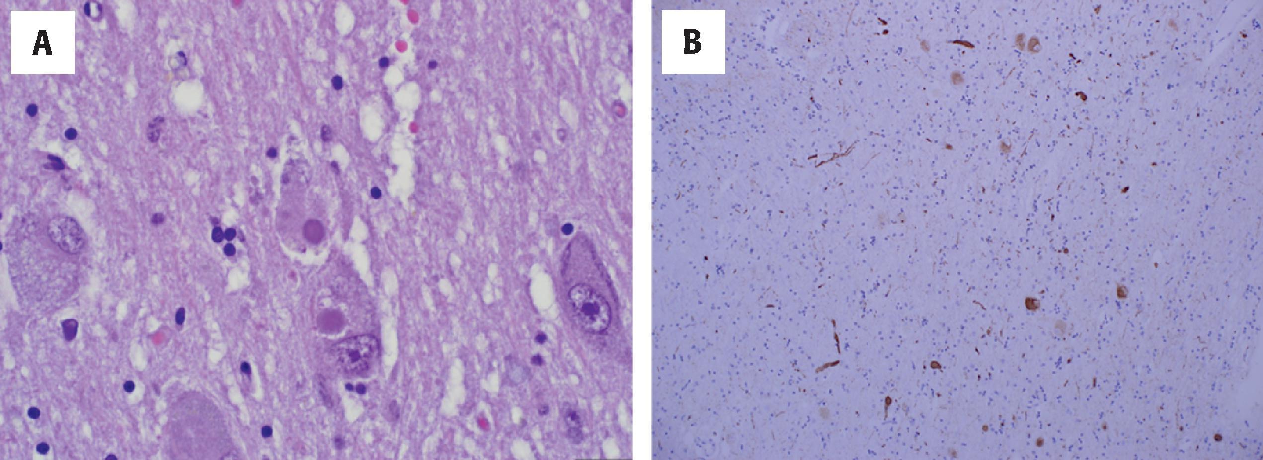 Figure 6.10, Lewy body pathology by H&E stains (A) often underestimates the full extent of pathology revealed by α-synuclein immunostain (B). This example is from the large cholinergic neurons of the basal forebrain (nucleus basalis) in a dementia with Lewy bodies patient and shows both Lewy bodies and Lewy neurites.