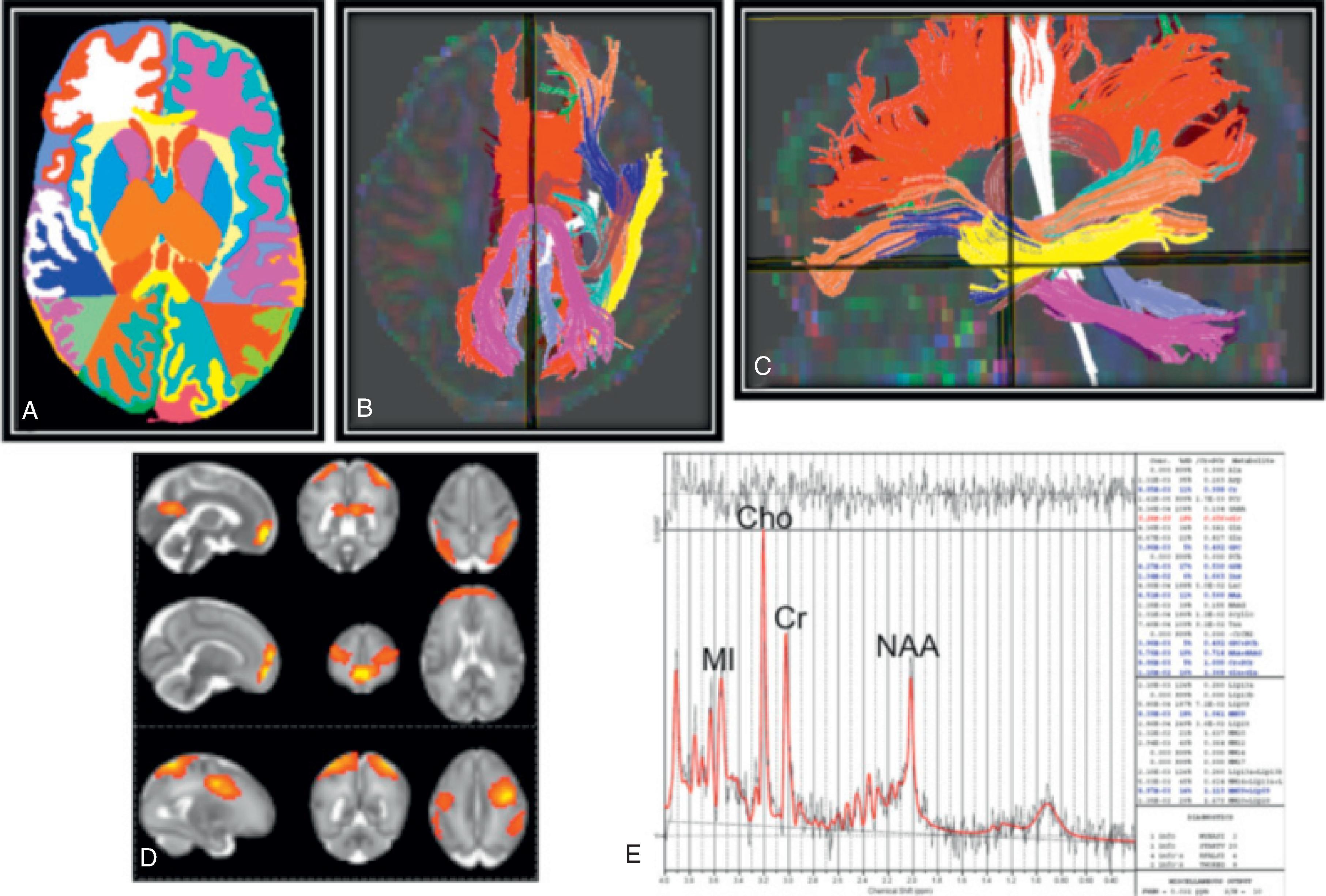 Fig. 96.1, (A) Brain-advanced magnetic resonance imaging (MRI) measurements including morphometry. (B and C) Diffusion tractography. (D) Functional connectivity MRI. (E) Magnetic resonance spectroscopy. Representative advanced MRI examples of an extremely low birth weight infant's brain at term-equivalent age display that was segmented into tissue classes, subcortical structures, and lobes (A); 10 white matter tracts, displayed in axial and sagittal orientations (B and C); panel D shows blood-oxygen level–dependent activations in the default mode (top panel), executive control (middle panel), and frontoparietal networks (bottom panel); and panel E is a processed proton magnetic resonance spectroscopy spectrum displaying the four main metabolites, including N-acetylaspartate (NAA), creatine (Cr), choline (Cho), and myo-inositol (MI).