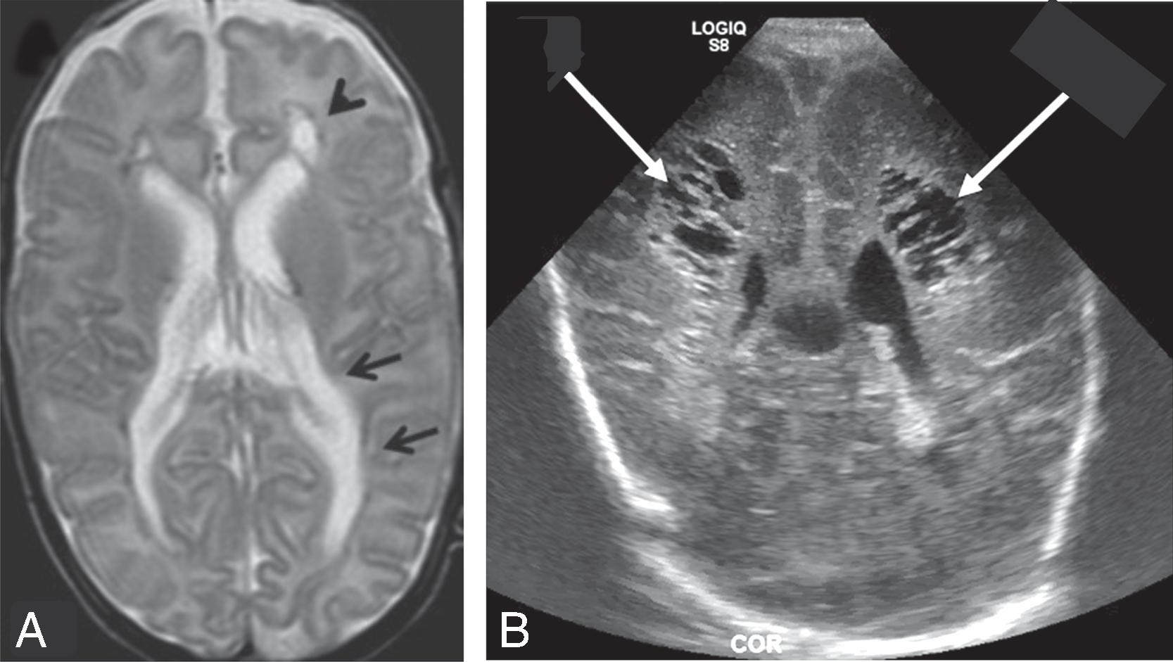 Fig. 96.3, Examples of Brain Injury in Premature Neonates .