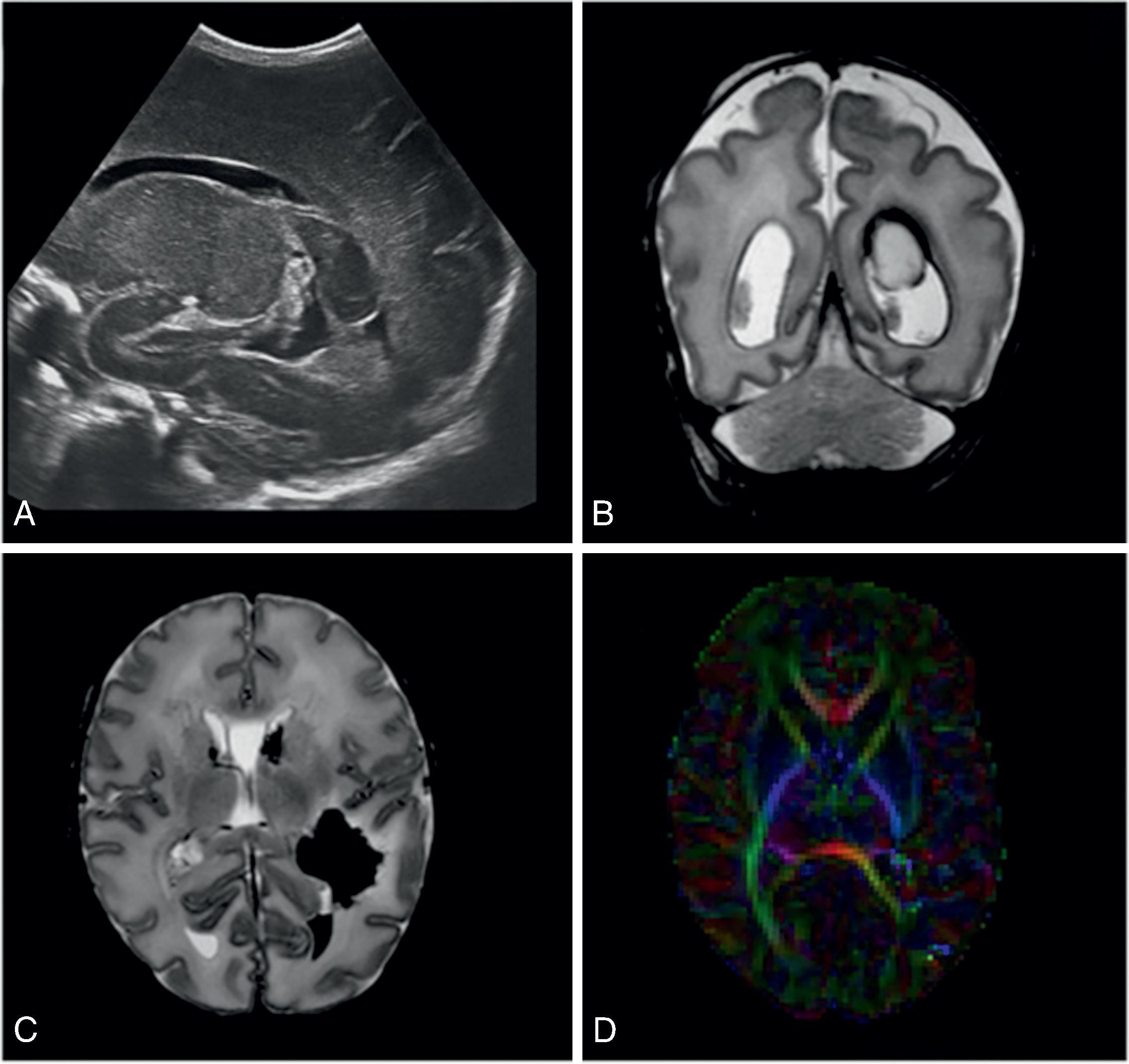 Fig. 96.4, Long-term Consequences of Moderate-Severe Intraventricular Hemorrhage (IVH) .