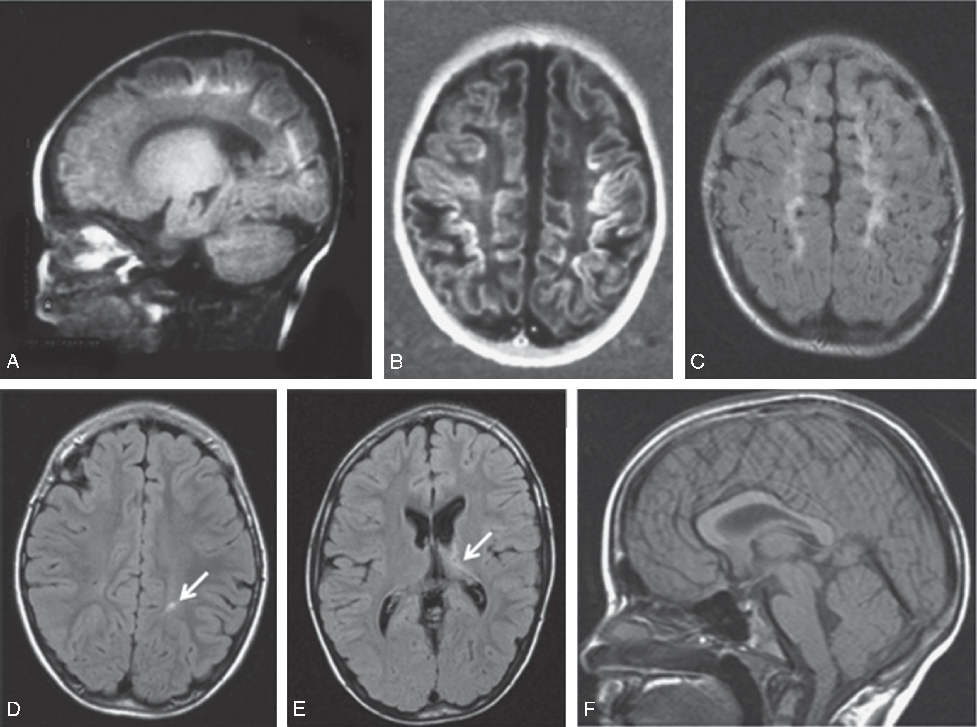 Fig. 96.5, Evolution of Neonatal Cerebral Injury Over a Decade .