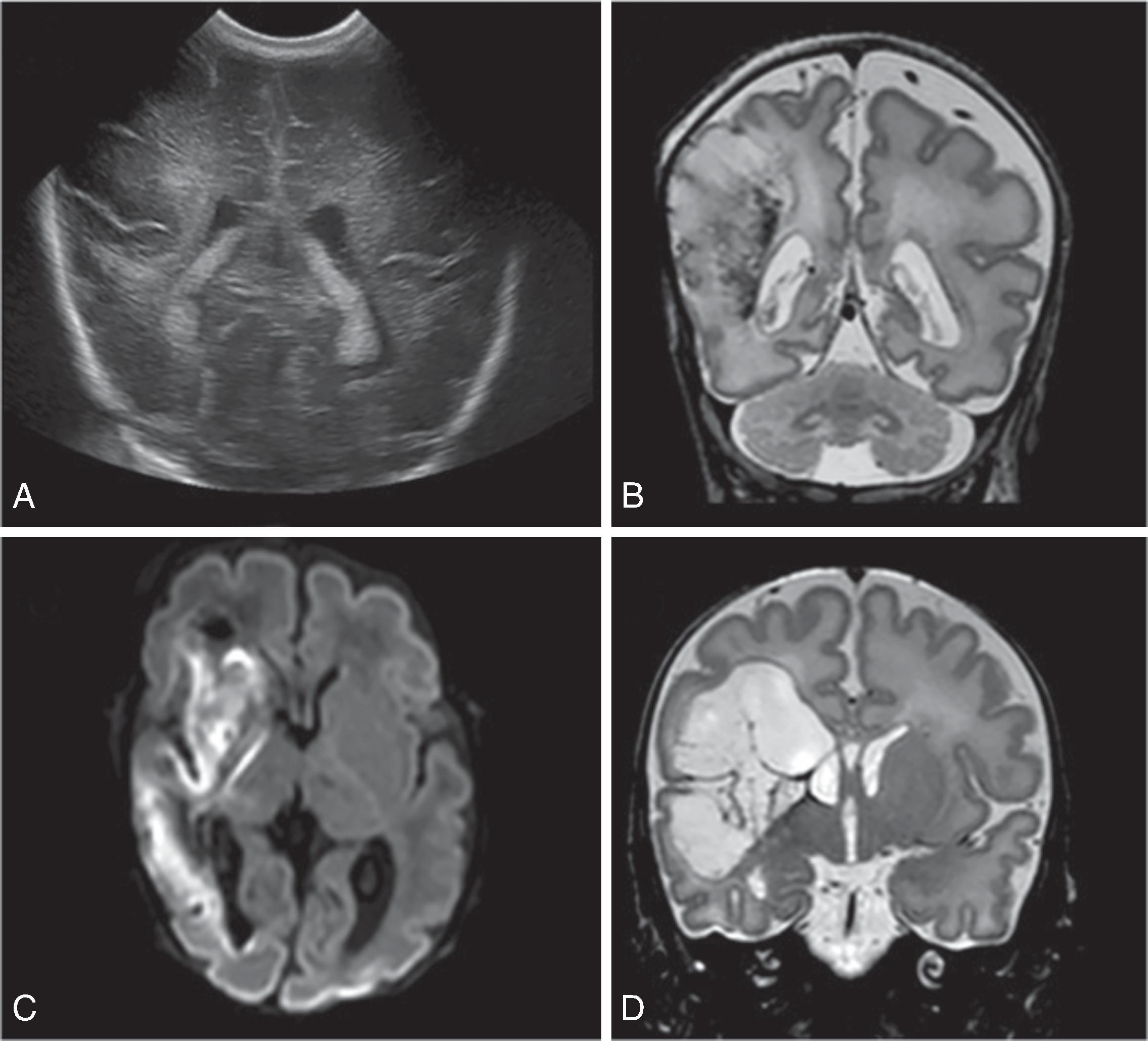 Fig. 96.6, Infants With Severe Systemic Illness Such as Necrotizing Enterocolitis (NEC) Can Develop Cerebral Changes .