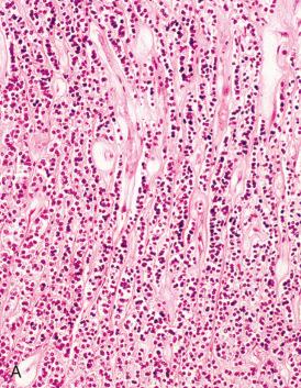 Fig. 15.1, Spectrum of neuroendocrine carcinomas of the cervix, beginning with A, low grade, and terminating in F, poorly differentiated, morphology.