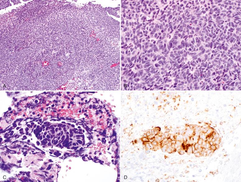 Fig. 15.11, A and B, Solid poorly differentiated carcinoma of the cervix. C, Needle biopsy of the lung recurrence. D, The lung tumor stains strongly for chromogranin.