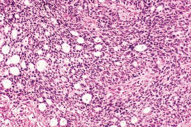 Fig. 15.13, Poorly differentiated carcinoma with features of both adenocarcinoma and neuroendocrine carcinoma.