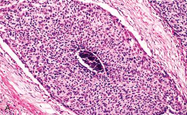 Fig. 15.14, Poorly differentiated non-neuroendocrine carcinomas. A, Nests of p63-negative poorly differentiated carcinoma associated with an adenosquamous carcinoma in situ. B, Undifferentiated papillary carcinoma associated with an adenocarcinoma. C, Undifferentiated papillary carcinoma of the cervix (HPV-18 positive). D, Note the variable p63 staining.