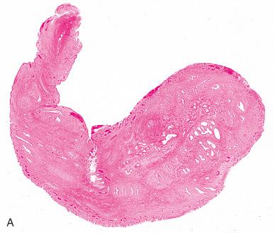 Fig. 15.16, A, Atypical endocervical polyp with mildly irregular glands. B, Slight gland irregularity may suggest adenosarcoma. The distinction from the latter requires attention to periglandular stromal accentuation, mitotic index, and nuclear atypia in the adjacent stroma. C, Higher magnification of mild periglandular stromal cuffing in an atypical stromal polyp. Note the tubal metaplasia in the glands, a feature that will not in itself distinguish this entity from adenosarcoma. D, Mild polypoid architecture on the surface of an atypical polyp.