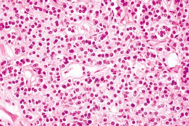 Fig. 15.2, Low-grade neuroendocrine carcinoma. Organoid arrangement of cells with uniform nuclei, minimal hyperchromasia, and low mitotic index.