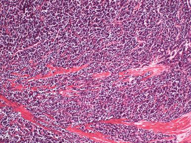 Fig. 15.4, Small cell neuroendocrine carcinoma (high-grade). A, The characteristic blue appearance reflects the high nuclear/cytoplasmic ratio and nuclear packing. B, At higher power, streams of loosely aggregated tumor cells invade the stroma with minimal inflammatory response. C, Tumor cells in a Papanicolaou (Pap) smear exhibit the characteristic nuclear molding.