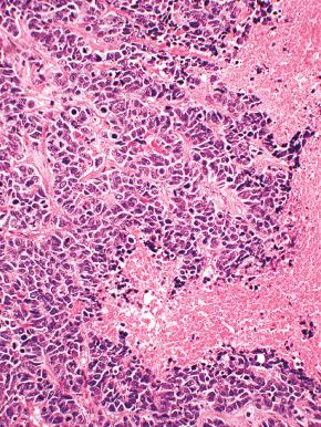 Fig. 15.6, Geographic necrosis in a poorly differentiated neuroendocrine carcinoma.