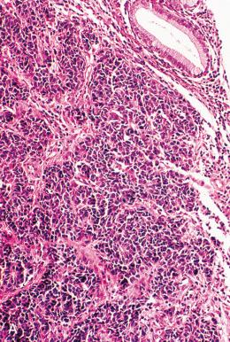 Fig. 15.7, A and B, Large cell neuroendocrine carcinoma (high-grade).