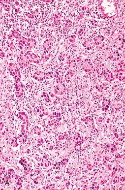 Fig. 15.9, A, Small tubules in a metastatic adenocarcinoma mimic neuroendocrine carcinoma. B, A primary adenocarcinoma forming small tubules with uniform nuclei.