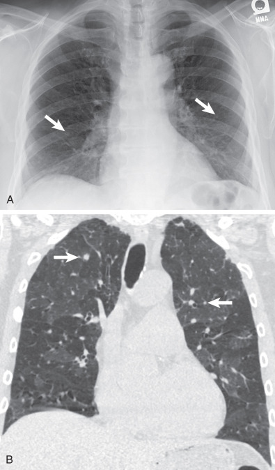 Fig. 19.1, Diffuse idiopathic pulmonary neuroendocrine cell hyperplasia. (A) Posteroanterior chest radiograph shows multiple small nodules (arrows) . (B) Coronal CT shows small pulmonary nodules measuring 2–8 mm (arrows). Note mosaic attenuation from associated constrictive bronchiolitis.