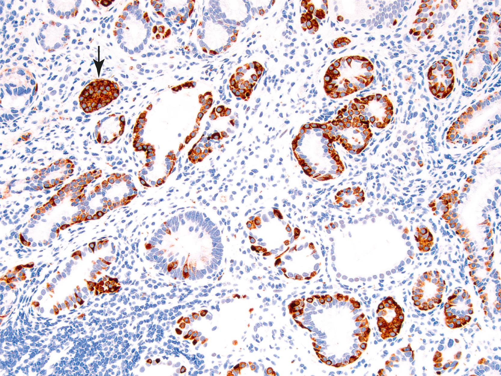 FIGURE 29.1, Incipient neuroendocrine tumor in the setting of autoimmune gastritis.