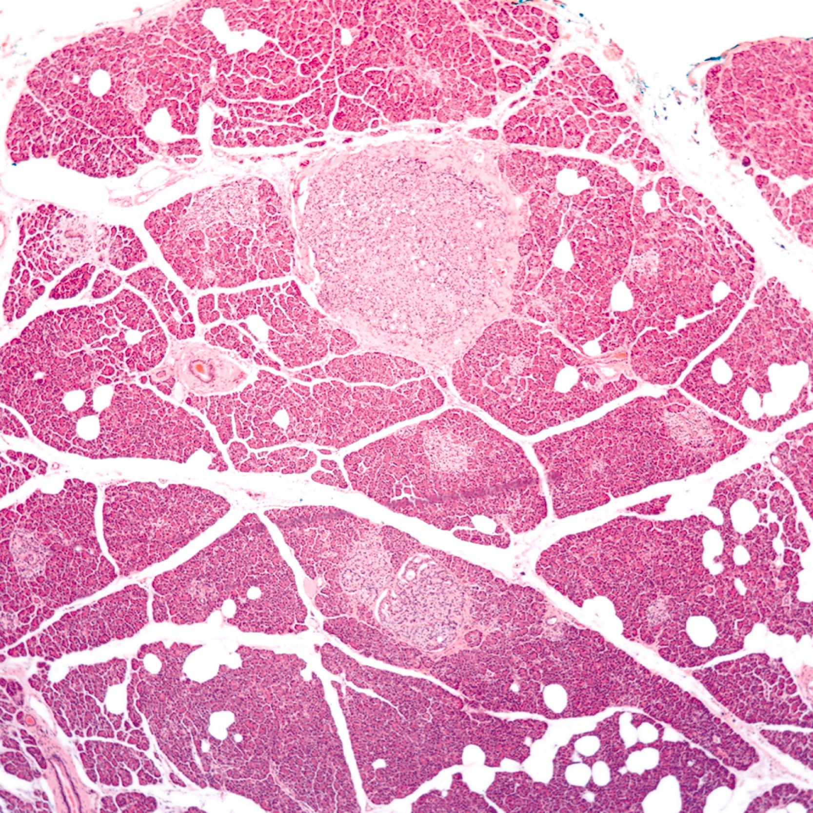 FIGURE 29.2, Incipient neuroendocrine tumor (NET) in a patient with MEN-1 syndrome. Micro-NET (so called microadenoma ) of the pancreas, characterized by a circumscribed nodule separated from the surrounding parenchyma by a thin band of fibrous tissue. Most examples of this phenomenon have a nesting or trabecular growth pattern and a clonal appearance, which can be highlighted by hormone immunostains.