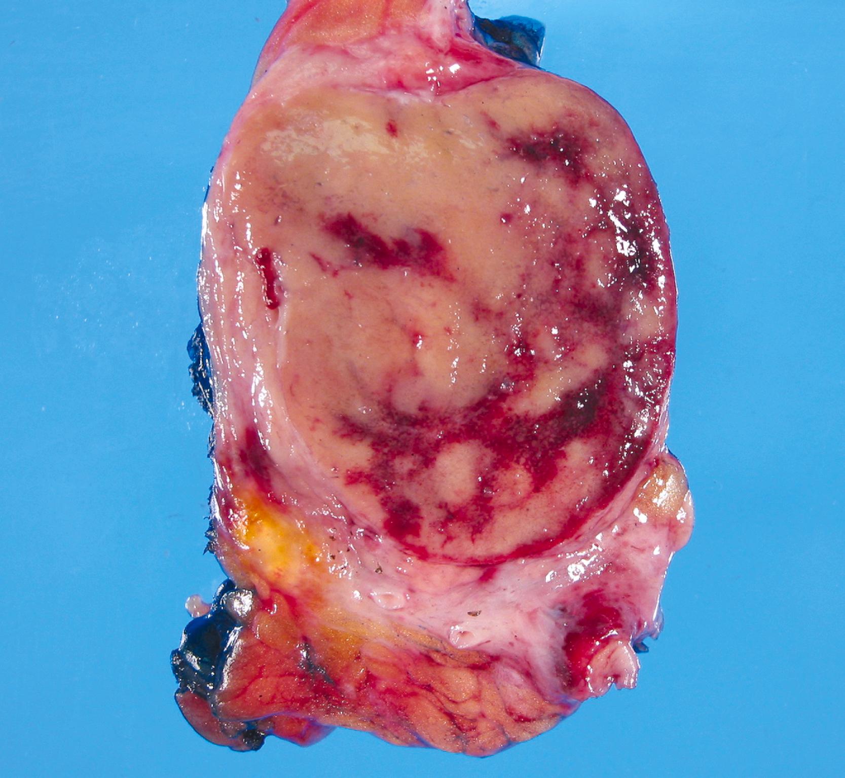 FIGURE 29.5, Gross appearance of a pancreatic well-differentiated neuroendocrine tumor. A solid and well-circumscribed tumor with a soft and fleshy consistency and foci of hemorrhage is shown.