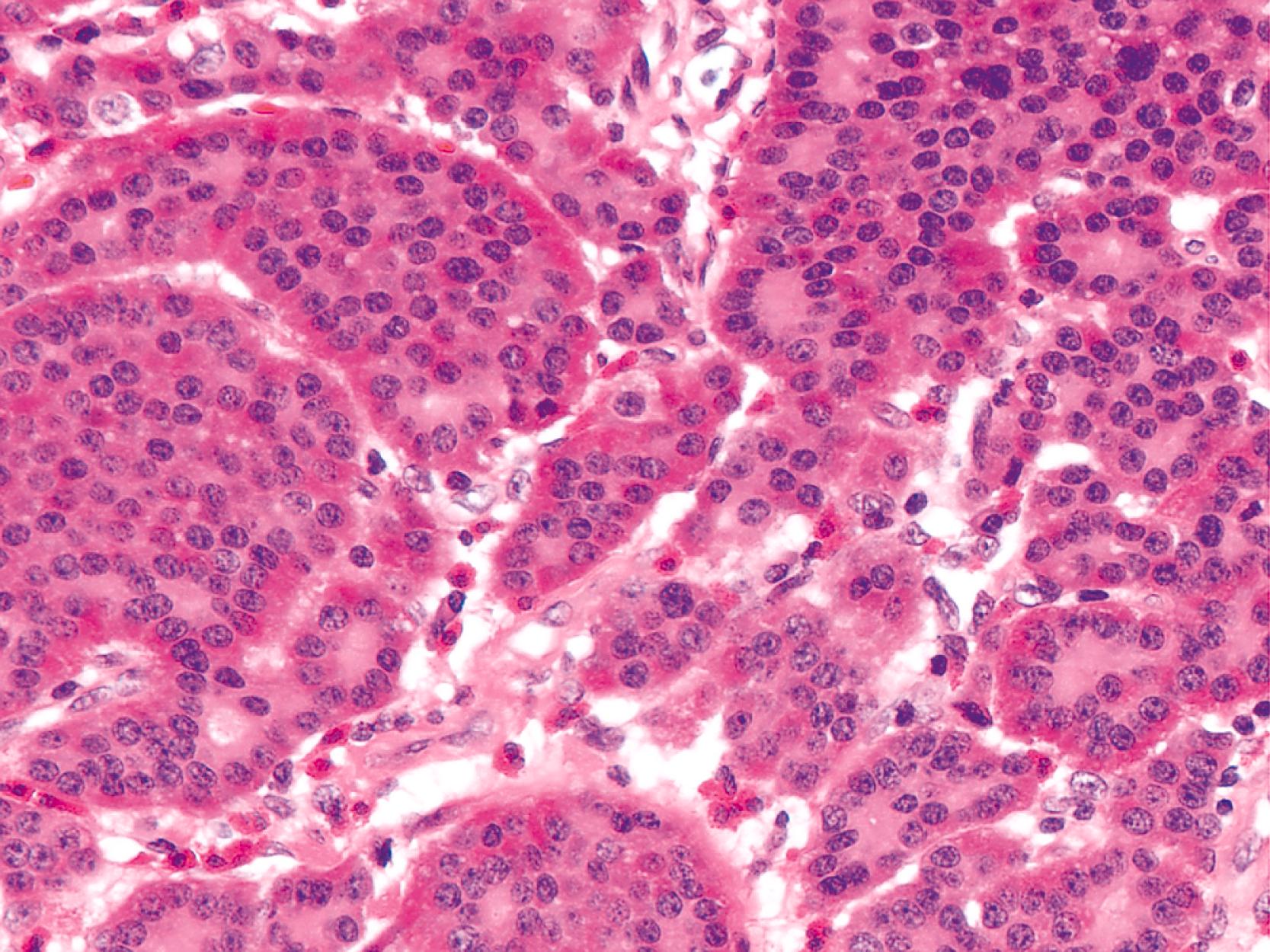 FIGURE 29.7, Although not specific, prominent intracytoplasmic granules at the periphery of the nests, combined with the peripheral rosette-like formations, are more characteristic of well-differentiated neuroendocrine tumors of midgut origin.