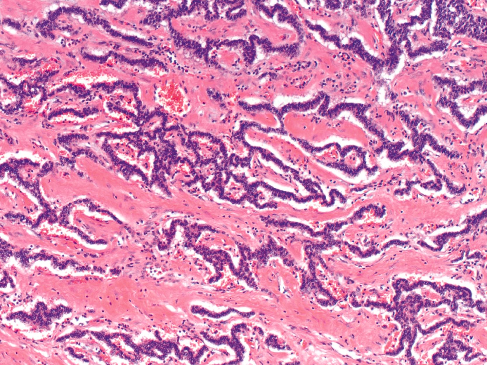 FIGURE 29.8, Trabecular and festoon patterns are characteristics of well-differentiated neuroendocrine tumors.