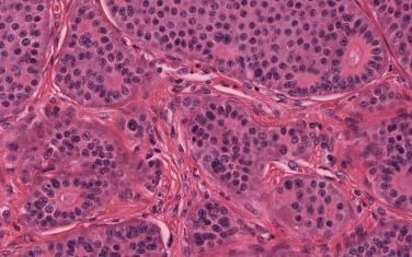 Fig. 55.1, Typical carcinoid shows an organoid nesting growth pattern and is composed of a homogeneous population of cells with finely granular cytoplasm chromatin and eosinophilic cytoplasm. No necrosis is seen, and if present, mitoses are rare.