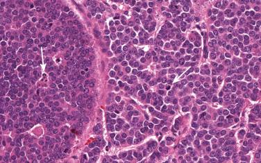 Fig. 55.2, Atypical carcinoid demonstrating increased mitoses (right arrow) , apoptotic bodies (left arrow) , and punctate necrosis seen within the nests and sheets of tumor cells.