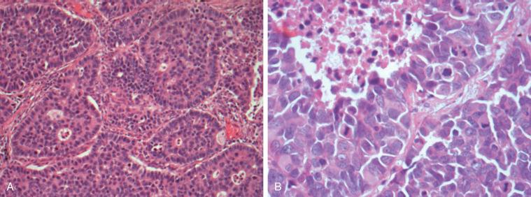 Fig. 55.3, (A) Large cell neuroendocrine carcinoma (hematoxylin and eosin, 100×). Nests of tumor cells with peripheral palisading and central necrotic foci and rosette-like structures. (B) High-magnification view (hematoxylin and eosin, 400×). Note large cells with abundant eosinophilic cytoplasm and round to oval nuclei with a fine granular (so-called salt-and-pepper) to more clumped chromatin with occasional nucleoli. Numerous mitotic figures and necrosis (upper left corner) are present.