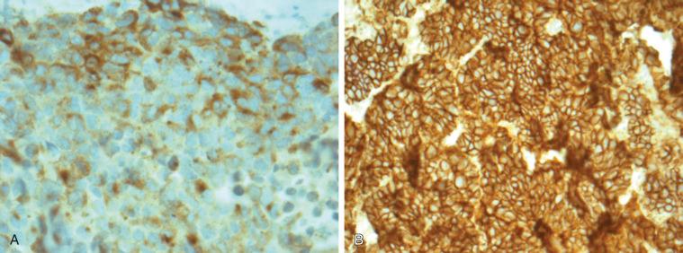 Fig. 55.4, Immunohistochemistry of a pulmonary large cell neuroendocrine carcinoma. (A) Granular cytoplasmic staining with chromogranin-A (100×); and (B) diffuse membrane positivity of CD56 (neural cell adhesion molecule, 100×) can be seen.