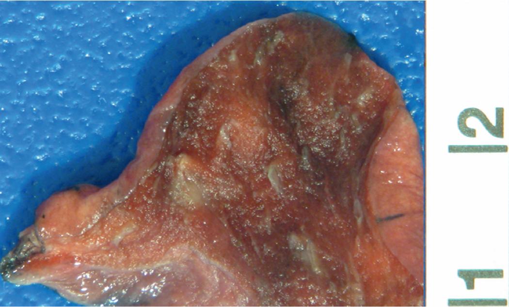 Figure 14.1, Tumorlet. Gross image of lung wedge shows a tan nodule near a bronchovascular bundle measuring about 3.0 mm which was a histologically proven carcinoid tumorlet.