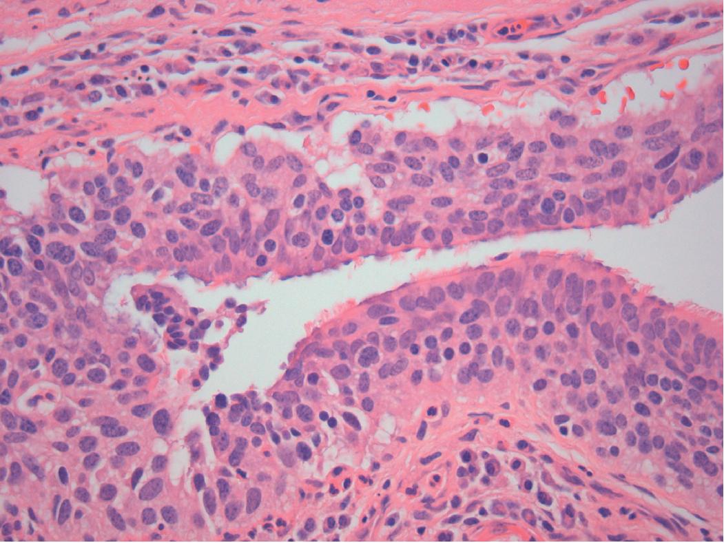 Figure 14.2, Diffuse idiopathic pulmonary neuroendocrine cell hyperplasia. Bronchiole with diffuse basal oriented cellular proliferation of uniform cells, round to spindled, with smooth nuclear contour and fine “salt-and-pepper” chromatin.