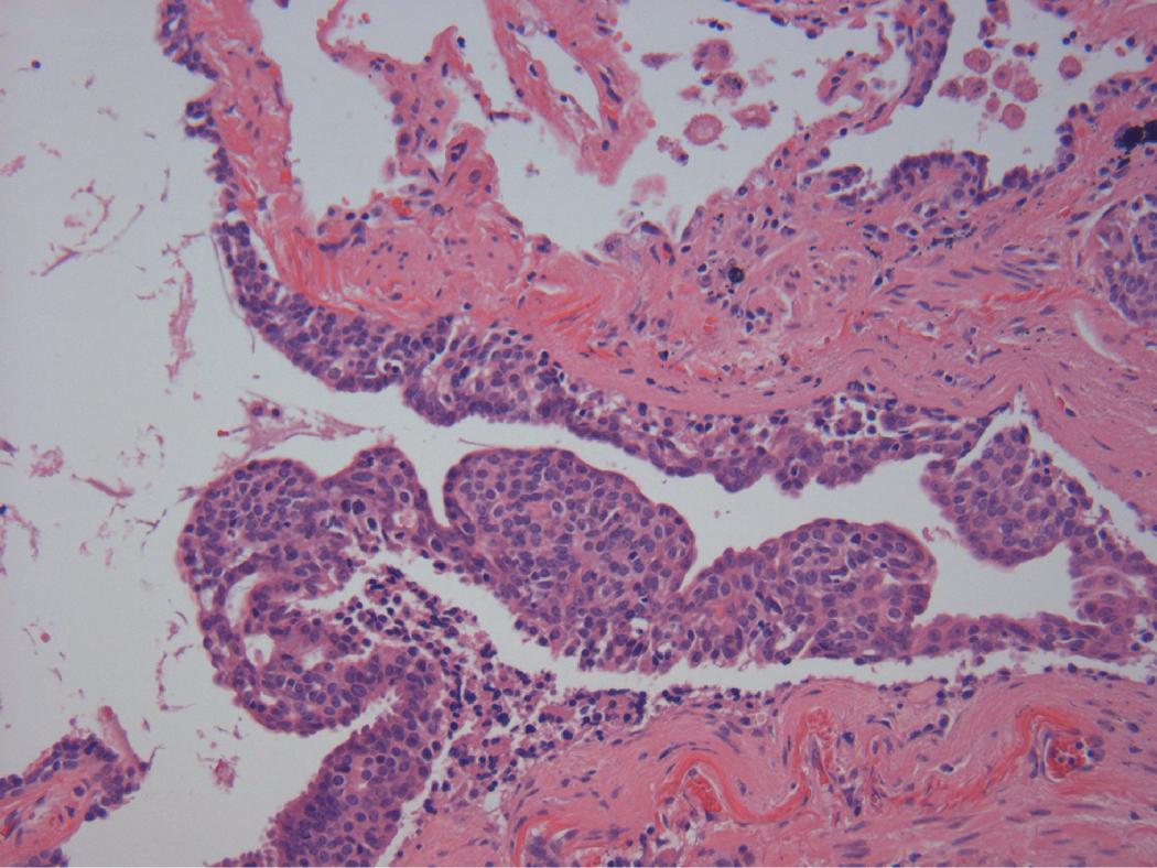 Figure 14.3, Diffuse idiopathic pulmonary neuroendocrine cell hyperplasia. Bronchiole with nodular aggregates of neuroendocrine cells, with thinning of the surface respiratory epithelial lining.