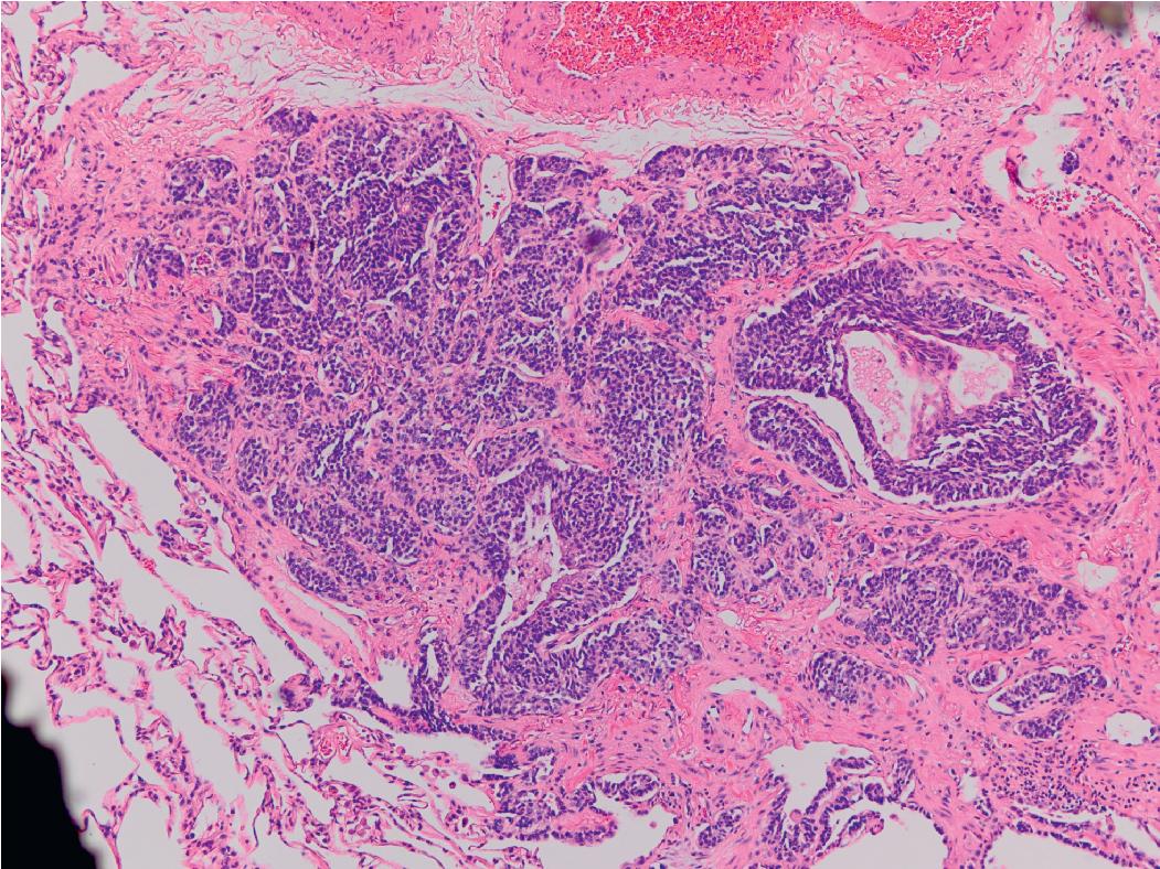 Figure 14.4, Carcinoid tumorlet. The neuroendocrine cell hyperplasia in the bronchiole is accompanied by a nodular proliferation of neuroendocrine cells next to the airway.