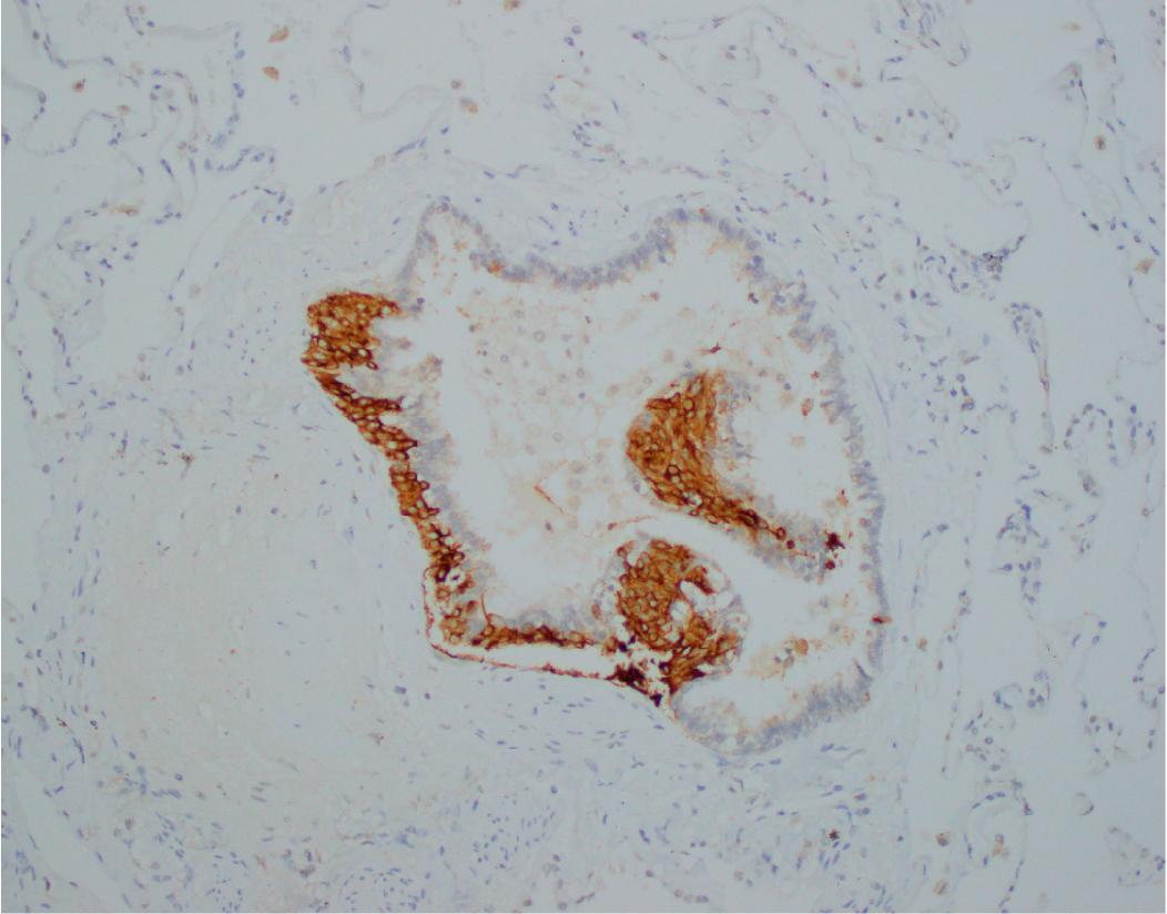 Figure 14.5, Diffuse idiopathic pulmonary neuroendocrine cell hyperplasia. Immunohistochemistry for synaptophysin highlights the neuroendocrine proliferation eccentrically involving the airway wall with projection into the lumen.