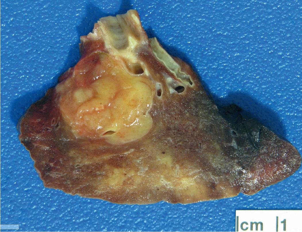 Figure 14.6, Carcinoid tumor. This lobulated yellow-tan tumor is associated with a bronchus, growing out into the adjacent lung parenchyma. Lung tissue distal to the tumor shows patchy consolidation, likely due to obstruction.