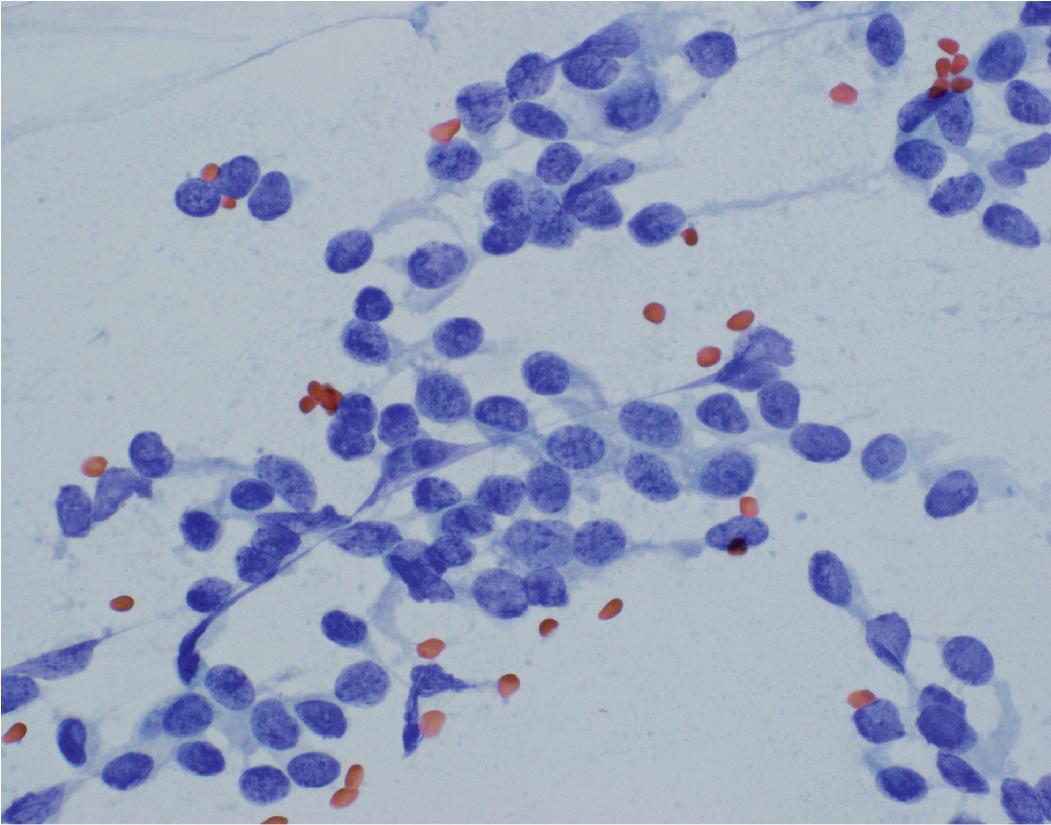 Figure 14.7, Carcinoid cytology. Clusters of uniform cells with round nuclei with fine chromatin (“salt-and-pepper”) and smooth nuclear contour are characteristic of carcinoid tumor.