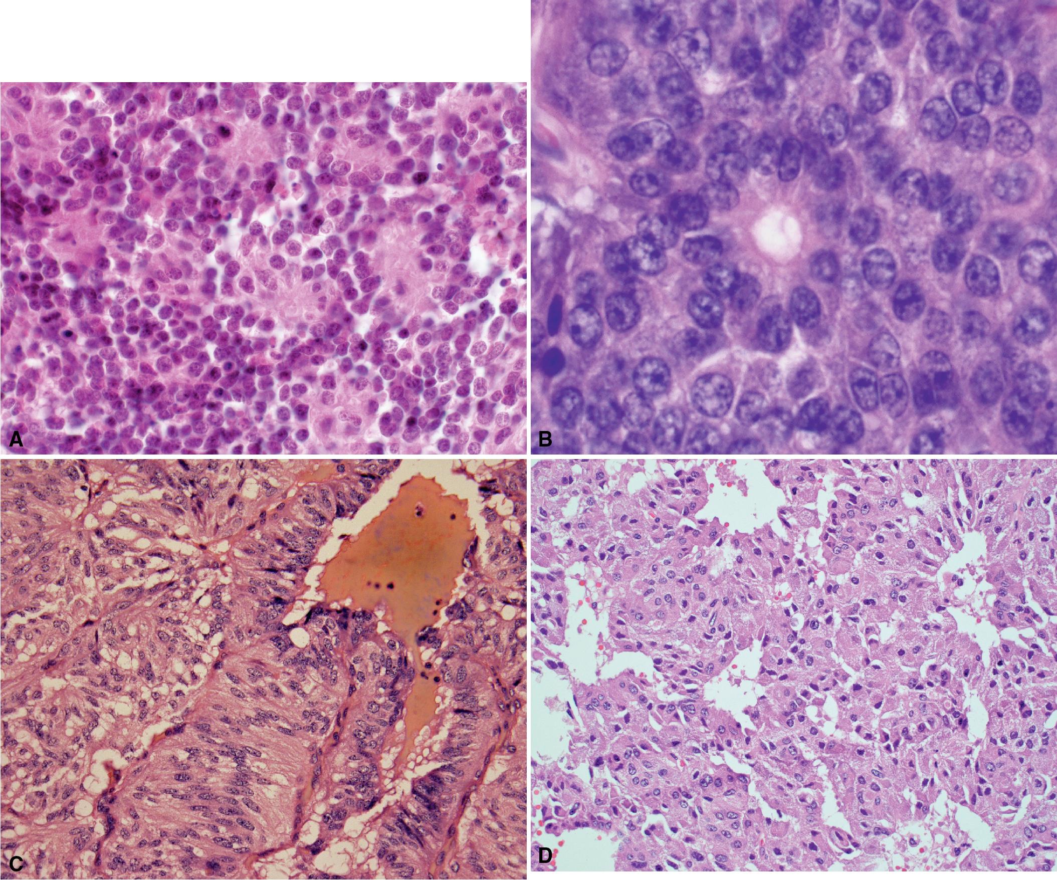 Figure 14.8, Cellular and architectural features of carcinoid tumors. (A) The cells of a carcinoid tumor are very uniform, and the nuclei are round with fine chromatin. This panel also shows rosette formation, an architectural feature. (B) Although fine chromatin is seen in the majority of cells, the presence of small chromocenters/ nucleoli can be seen in carcinoids; a rosette is also present in this field. (C) The cells in a spindle cell carcinoid are long and narrow with elongated nuclei, but still uniform with fine chromatin. (D) Uniform cells with abundant eosinophilic cytoplasm in an oncocytic carcinoid.