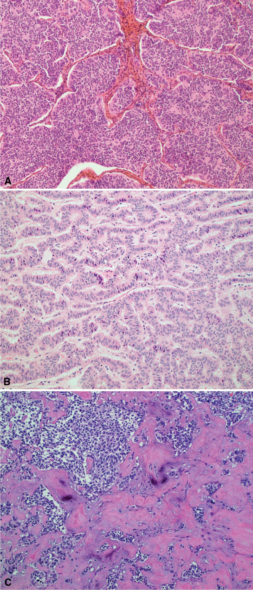 Figure 14.9, Architectural features of carcinoid tumors. (A) Organoid patterns show solid nests of cells with intervening fine vascularity as seen in this image or in other cases fibrous tissue. (B) Ribbon-like arrangements of cells in a trabecular pattern. (C) Stromal fibrosis with focal calcification is seen.