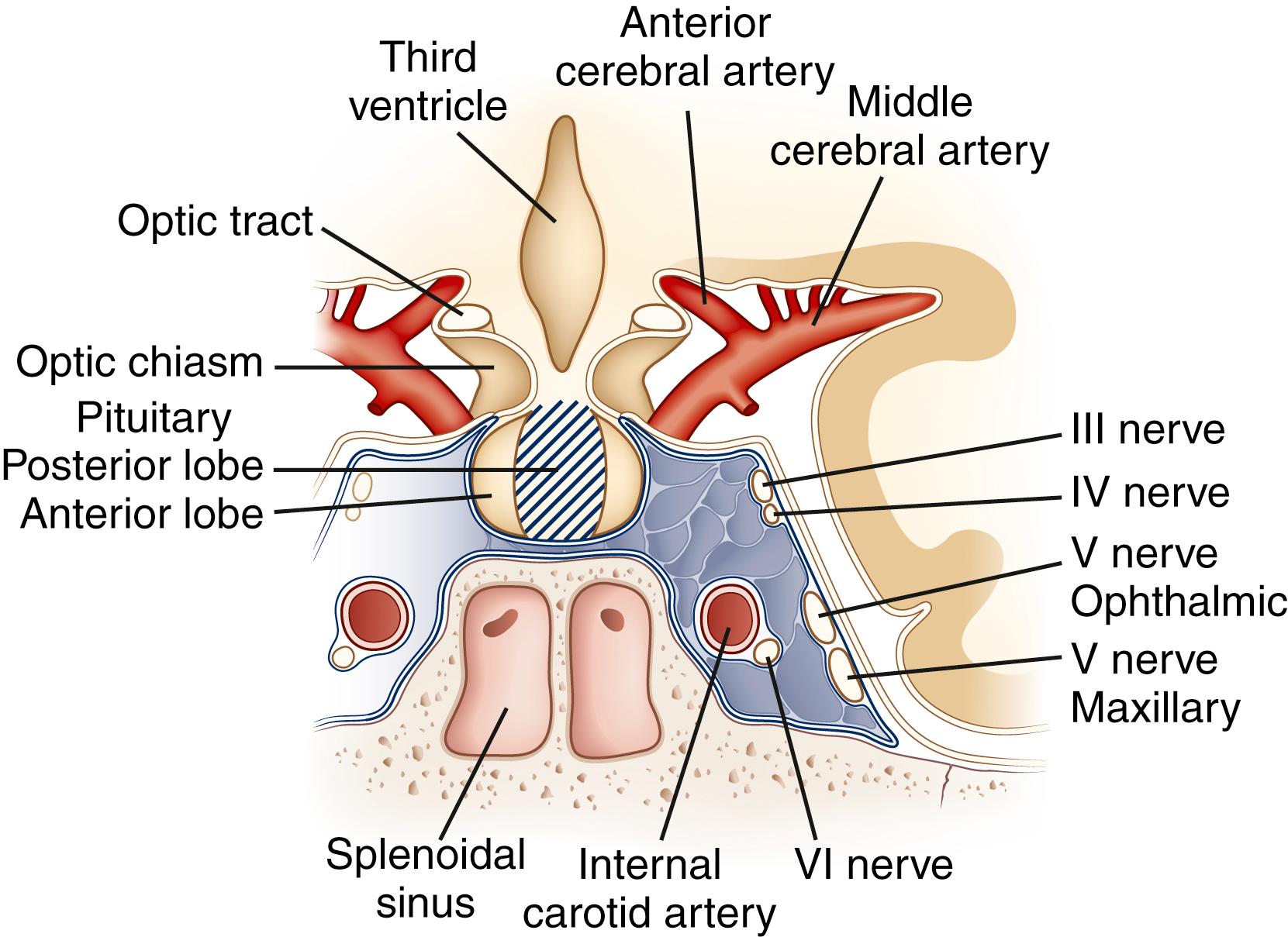 Fig. 50.3, Diagrammatic Representation of the Anatomical Relations of the Pituitary Fossa and Cavernous Sinus. The lateral wall of the sella turcica is formed by the cavernous sinus. The sinus contains the carotid artery, two branches of the fifth cranial nerve (the ophthalmic and maxillary nerves), third nerve (oculomotor), fourth nerve (trochlear), and sixth nerve (abducens). The optic chiasm and optic tract are located superior and lateral, respectively, to the pituitary.