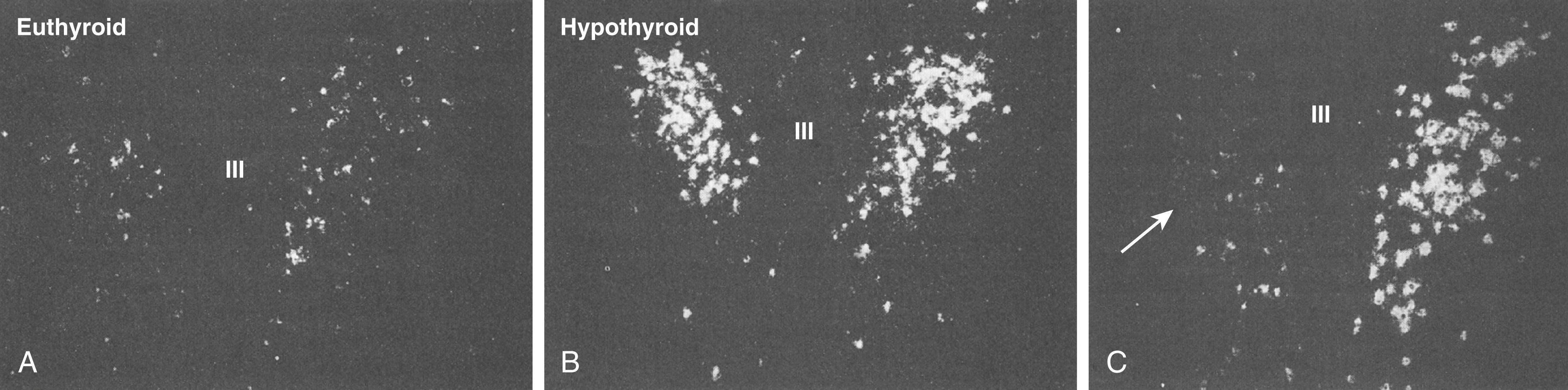 FIGURE 204-2, In situ hybridization autoradiographs of proTRH mRNA in the paraventricular nucleus of ( A ) euthyroid and ( B ) hypothyroid rats.