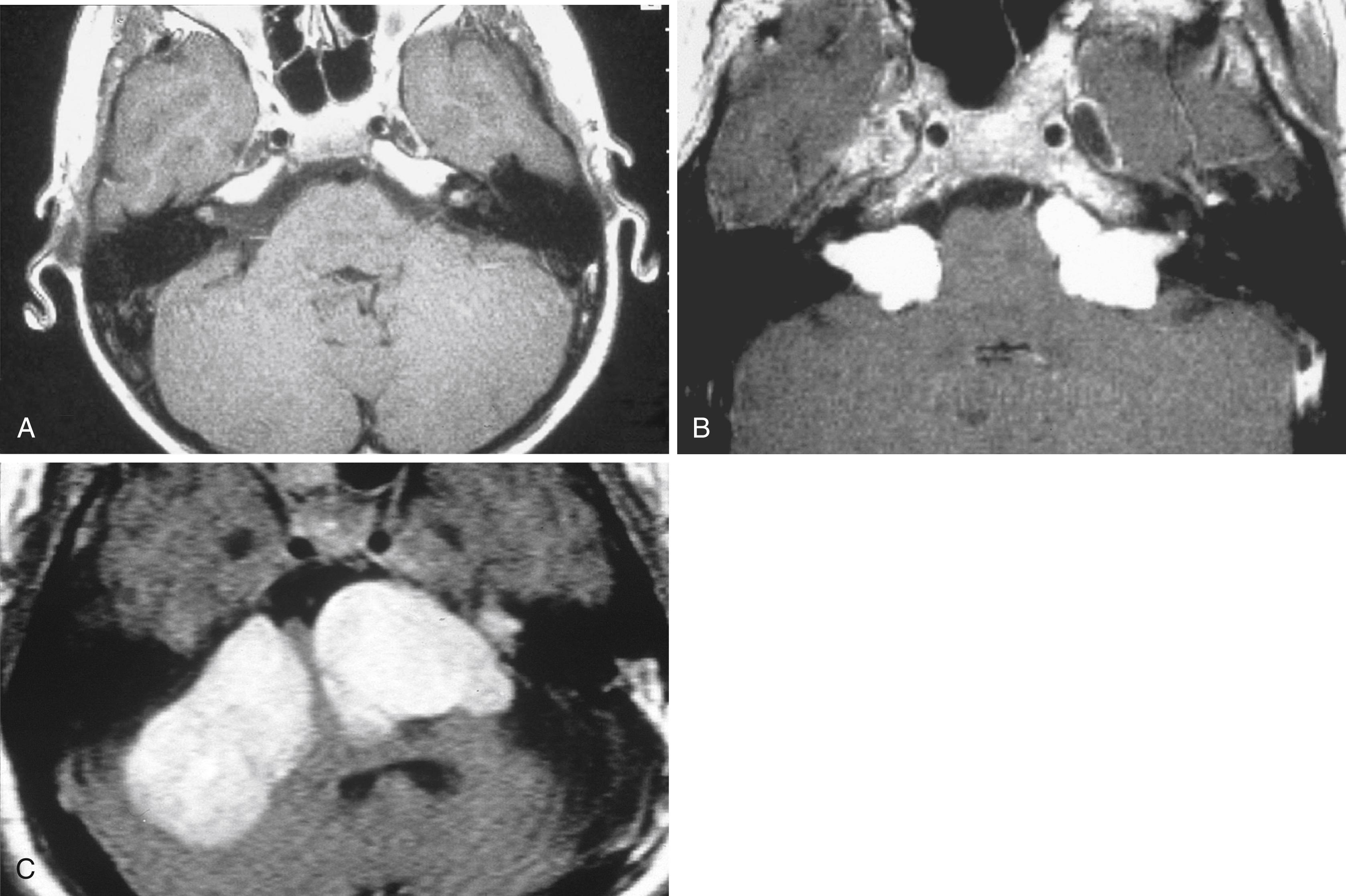 Fig. 52.2, Bilateral vestibular schwannomas are characteristic of neurofibromatosis 2.