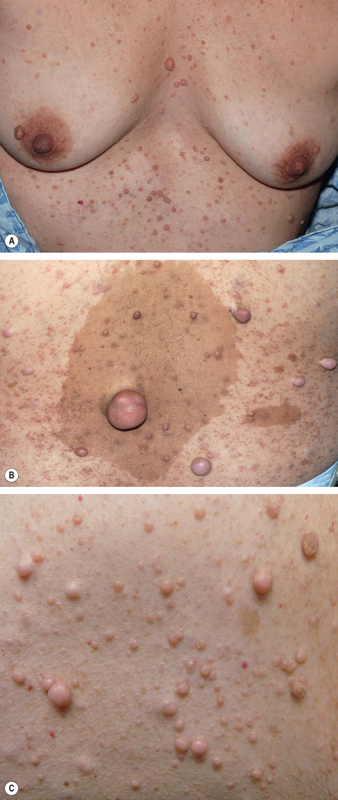 Fig. 61.4, Multiple cutaneous neurofibromas.