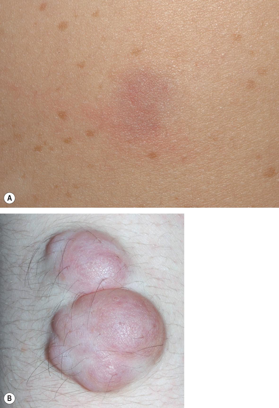 Fig. 61.5, Spectrum of cutaneous neurofibromas.