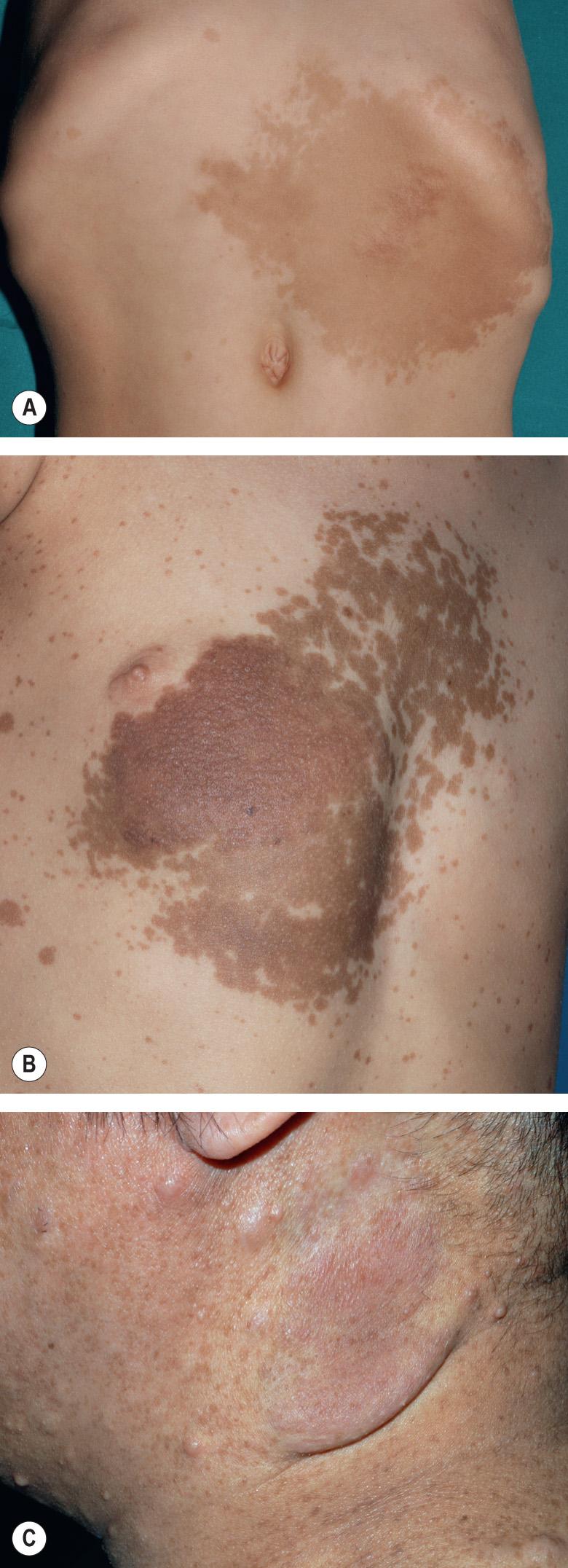 Fig. 61.6, Plexiform neurofibromas.