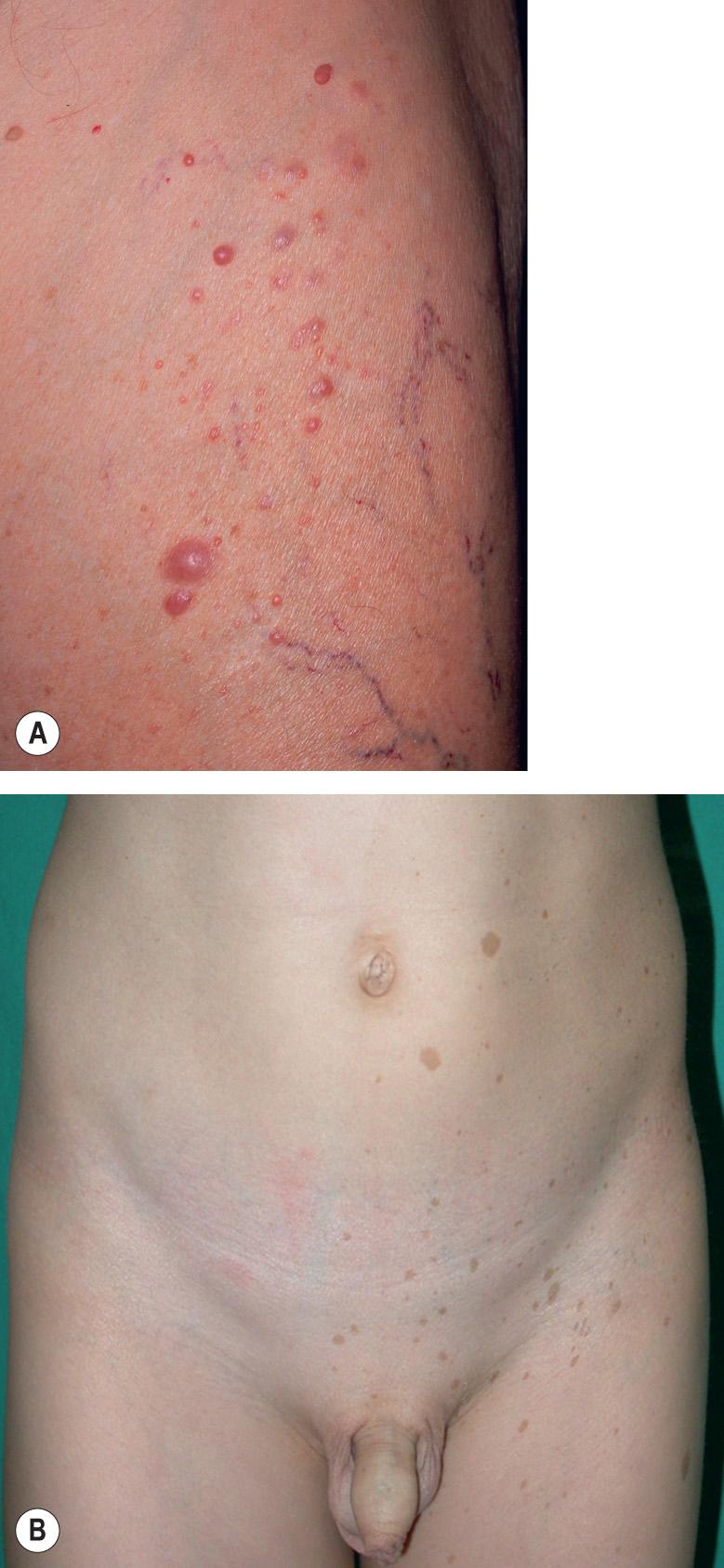 Fig. 61.8, Mosiac neurofibromatosis.