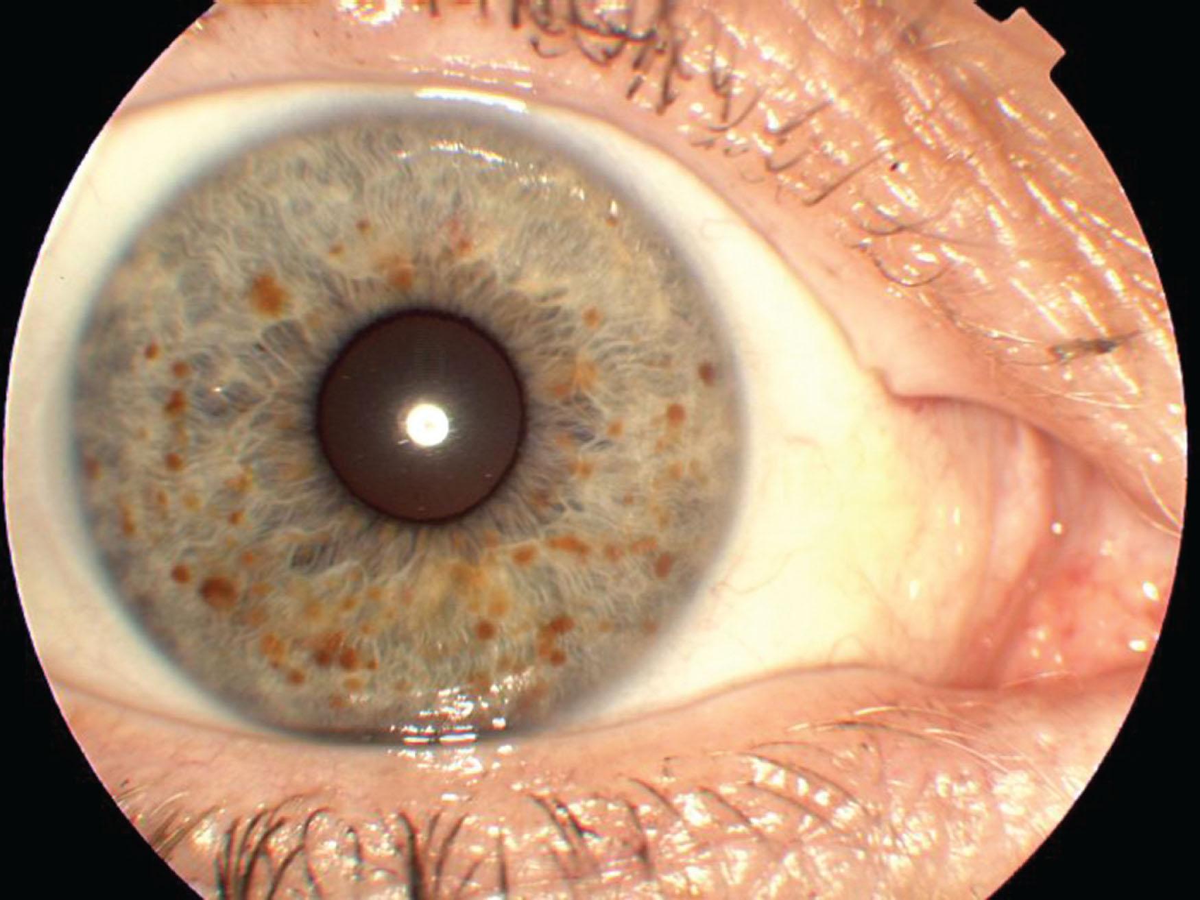 Fig. 69.1, Lisch nodules. These elevated brown nodules are predominately seen on the lower half of the iris in a patient with familial neurofibromatosis type 1.