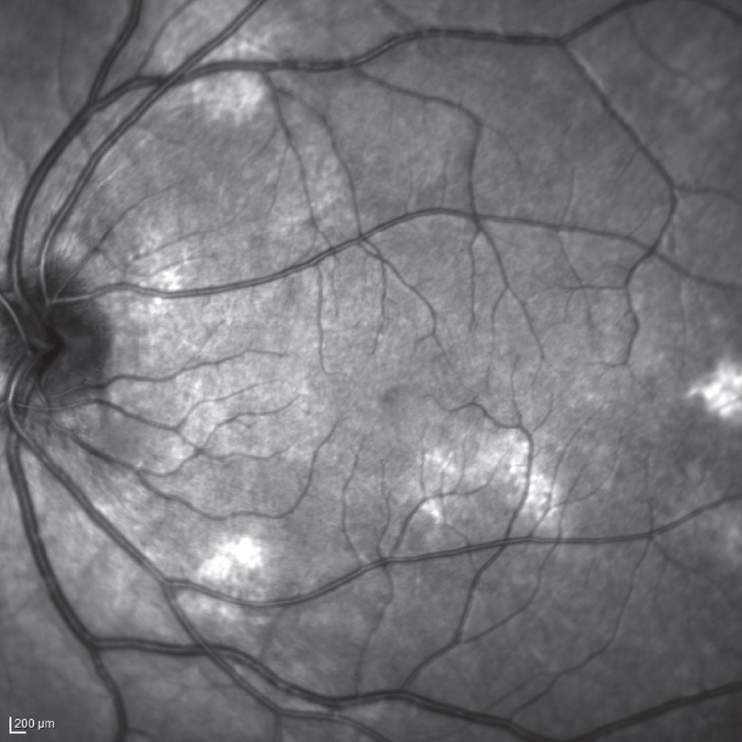 Fig. 69.2, Near-infrared image acquired with optical coherence tomography demonstrating patchy areas of hyperintensity consistent with choroidal abnormalities secondary to neurofibromatosis type 1.